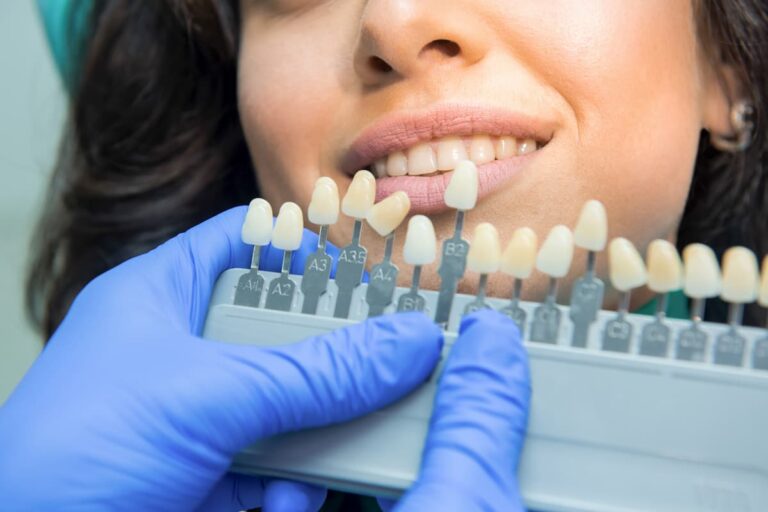 estetica dental carillas