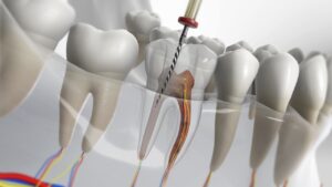 endodoncia arganzuela