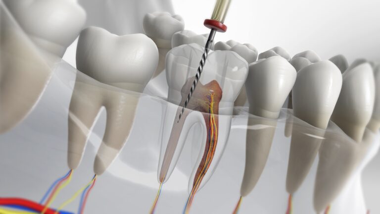 endodoncia arganzuela