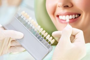 Blanqueamiento dental profesional