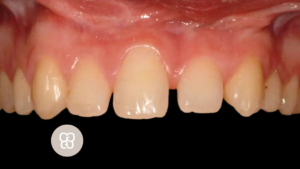 agenesia dental acedo