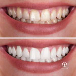 Como afecta el tabaco en los dientes