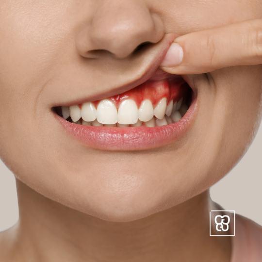 Como desinflamar un absceso dental Clinica dental ferrocarril Dentista