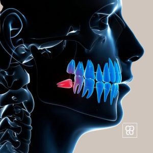 Diente impactado Clinica dental ferrocarril dentista