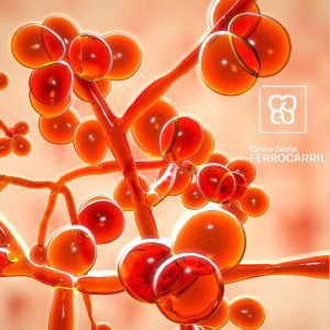 Es grave la candidiasis oral Clinica ferrocarril Arganzuela