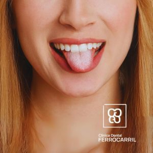 Es grave la candidiasis oral Clinica ferrocarril Arganzuela
