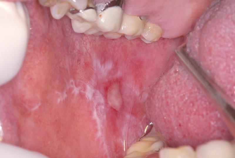 Liquen plano oral ferrocarril