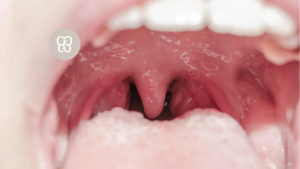 Uvulitis tratamiento