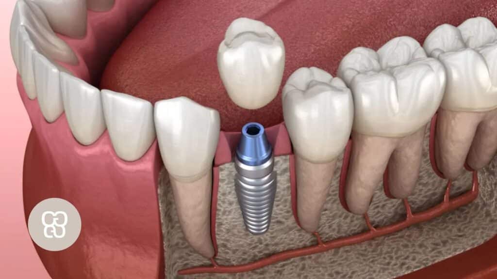 Reducir el tiempo en la colocación de un implante dental