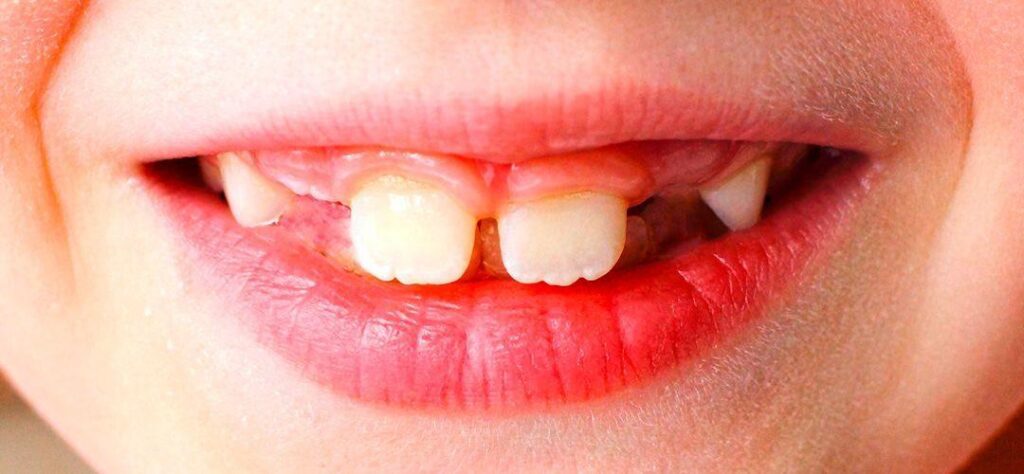 agenesia dental acedo