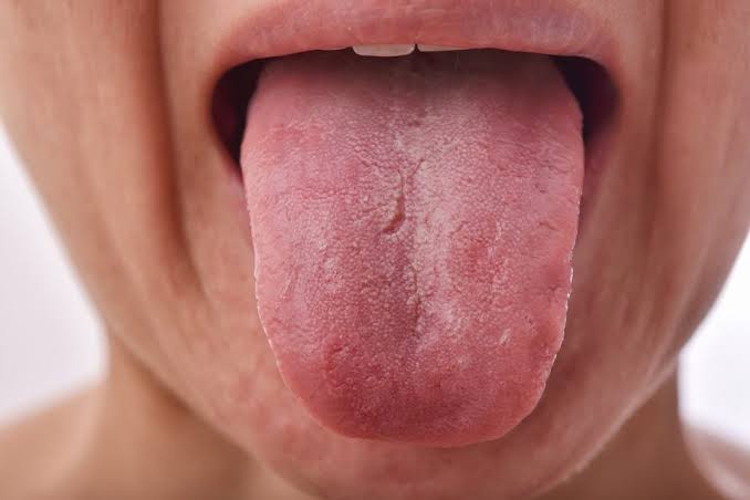 candidiasis oral