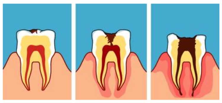 proceso caries dental