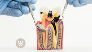 caries dental ferrocarril