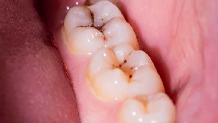 caries dental arganzuela
