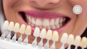 mejores carillas dentales