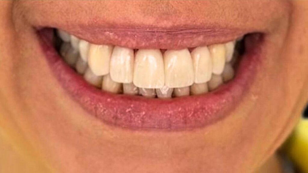 antes y despues carillas dentales