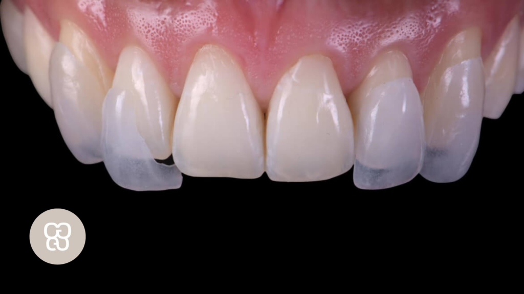 mejores carillas dentales