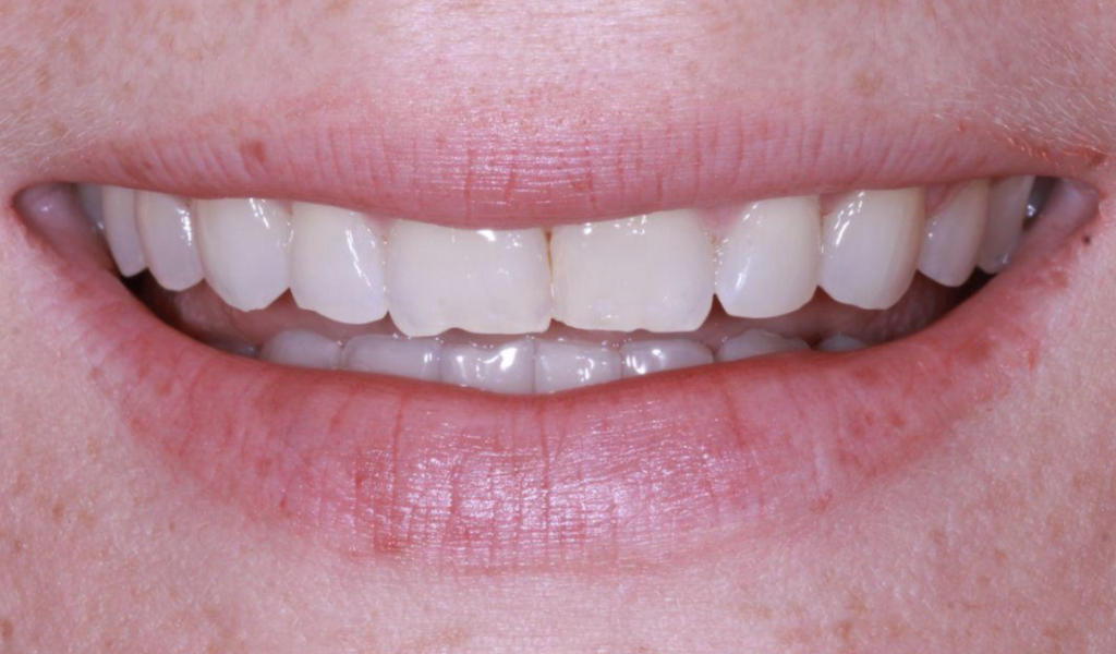 estética dental con carillas