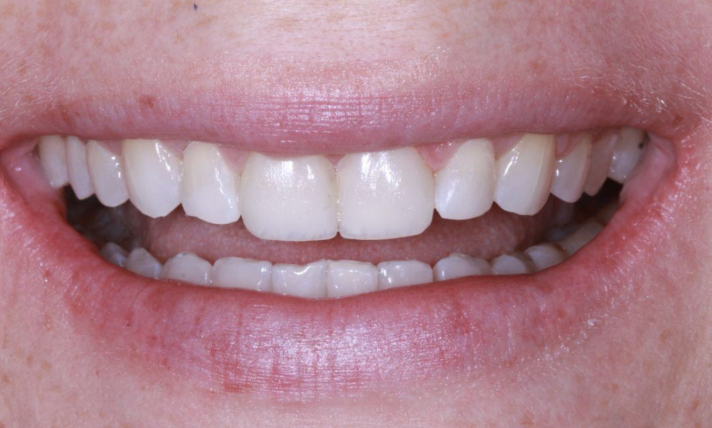 estética dental con carillas