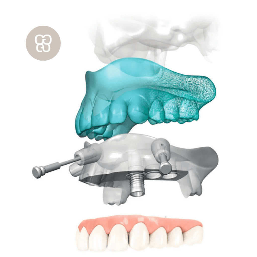 técnica de cirugía guiada en clínica dental ferrocarril