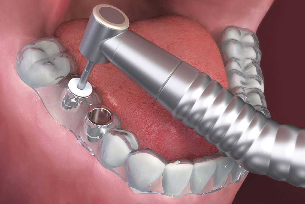 cirugía guiada en clinica dental ferrocarril