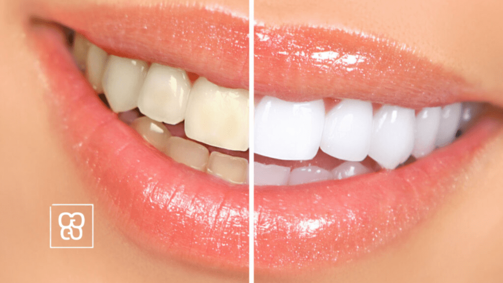 blanqueamiento dental profesional con Clínica Dental Ferrocarril