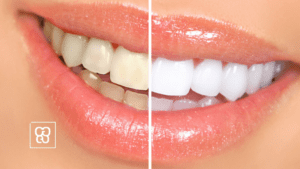 blanqueamiento dental profesional con Clínica Dental Ferrocarril
