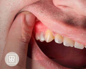 Cómo eliminar el sarro de los dientes