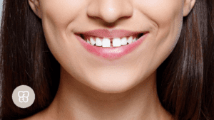 diastemas clínica dental ferrocarril