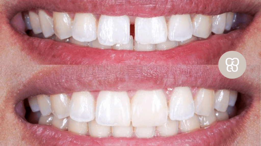 tratamientos diastemas en clínica dental ferrocarril