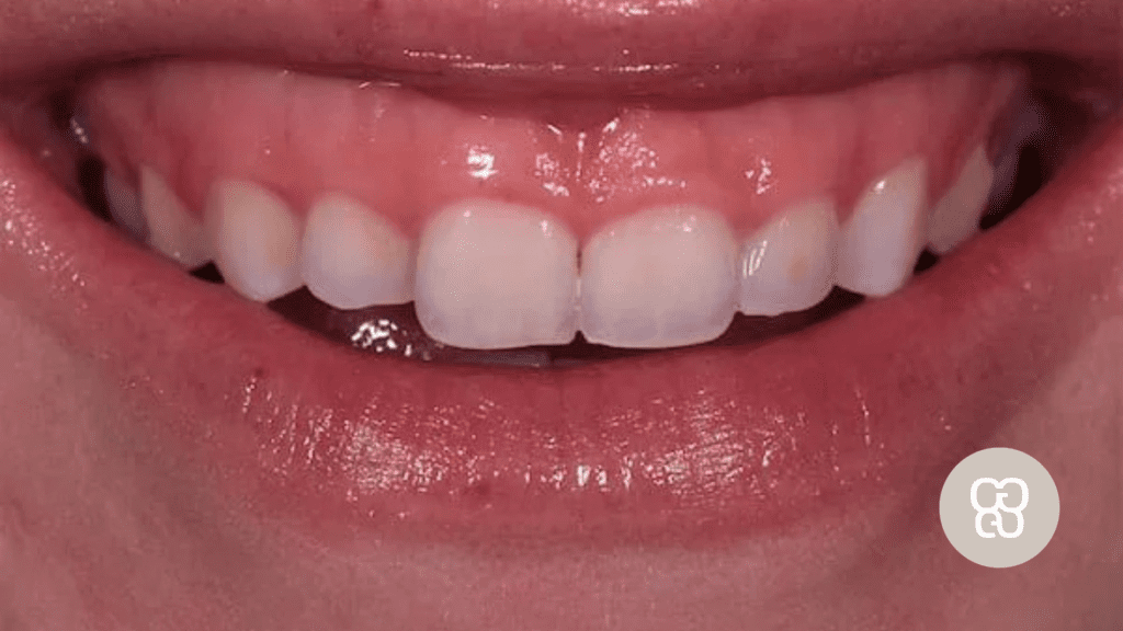 Dientes cortos
