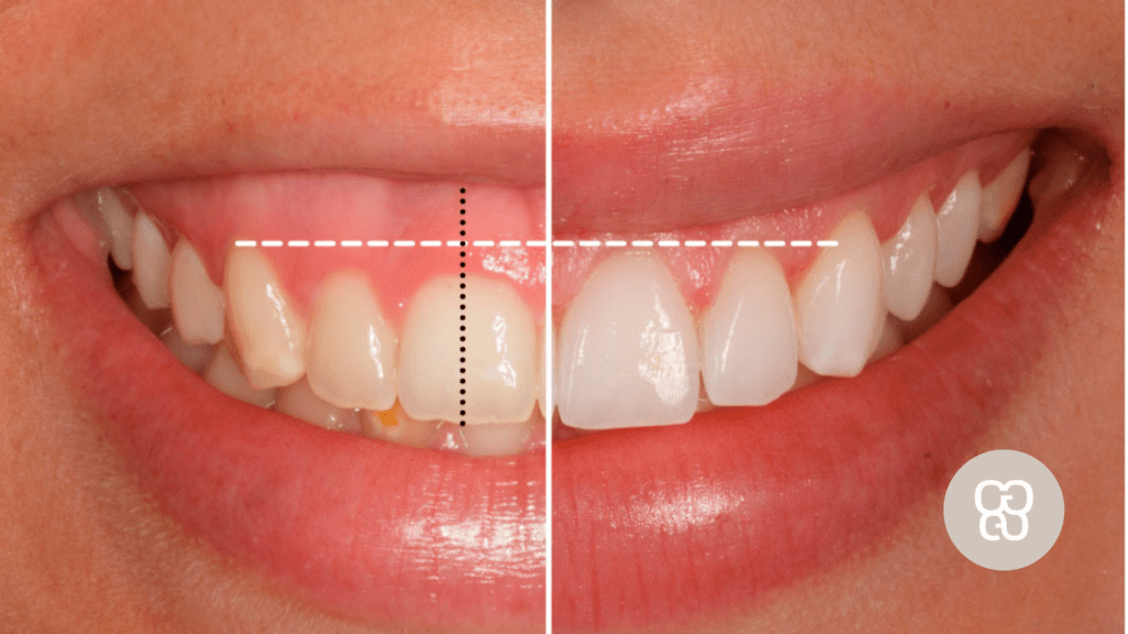 Dientes cortos