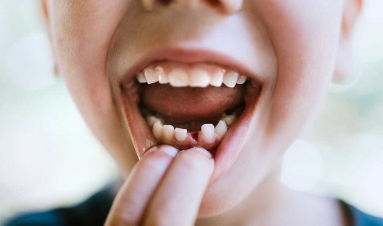 caída dientes de leche de un niño
