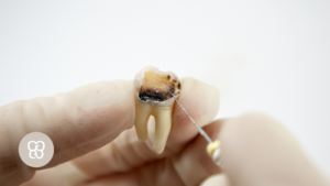 Duele una endodoncia