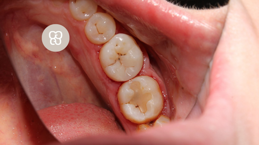 tipos de empastes dentales