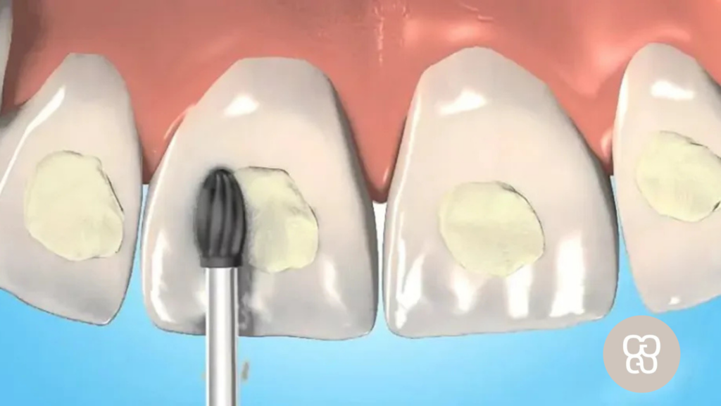 empastes en la clínica dental ferrocarril