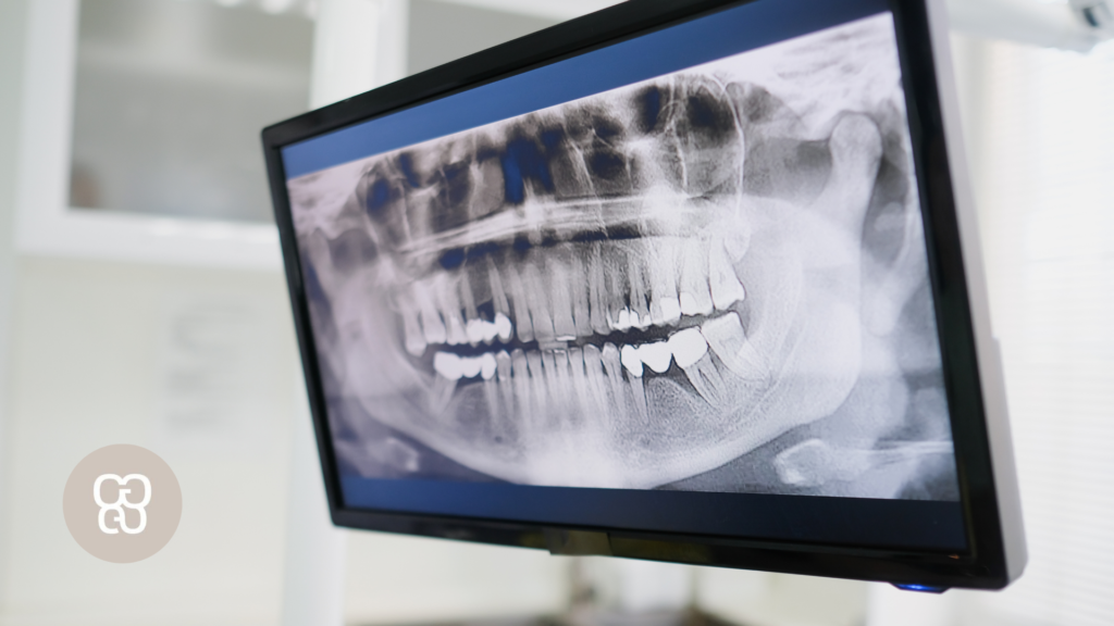 Duele una endodoncia