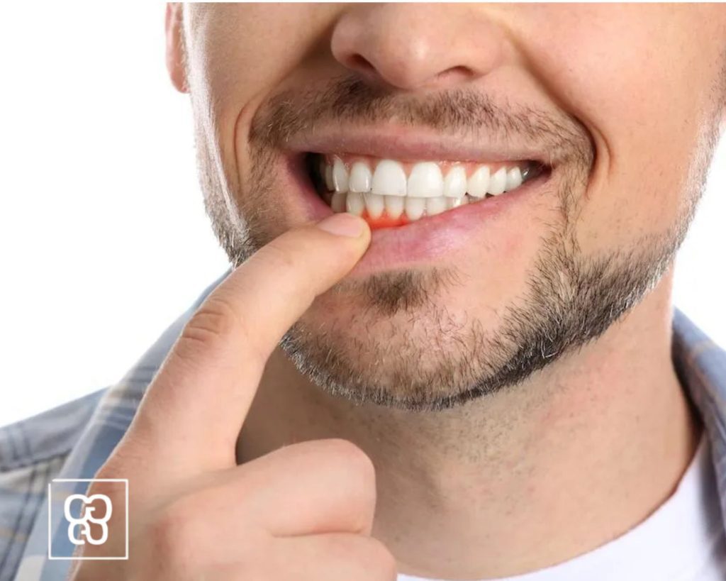 enfermedad periodontal periodontitis