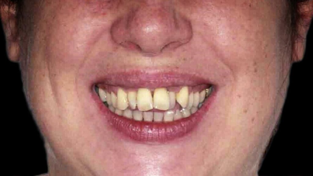 antes y despues enfermedad periodontal ortodoncia