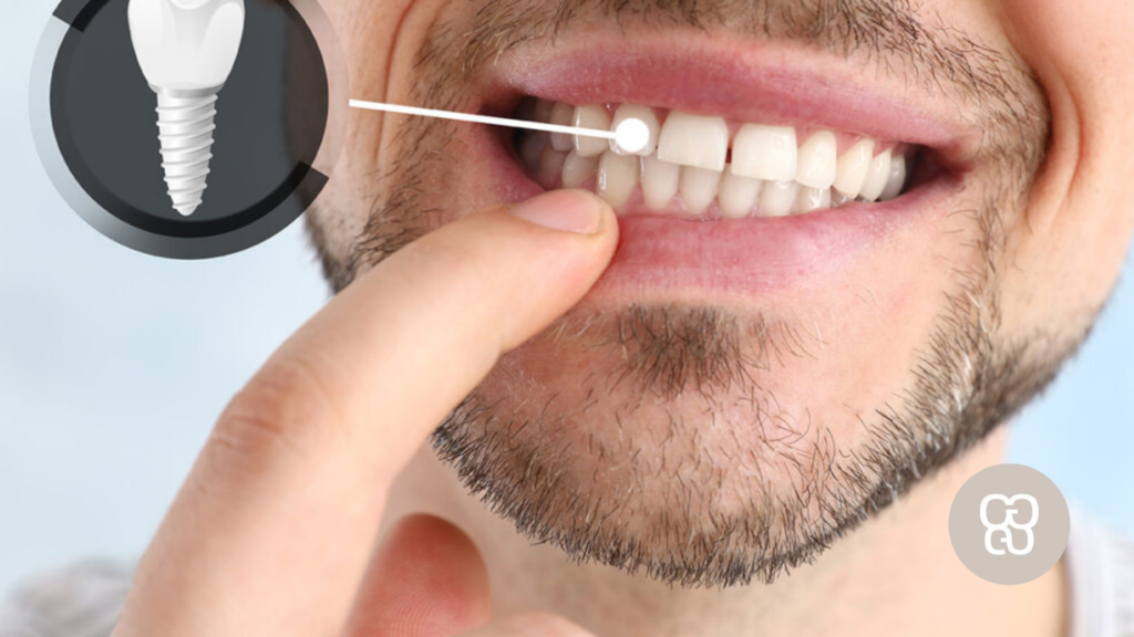 Errores después de ponerse un implante dental