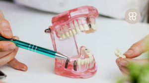 Errores después de ponerse un implante dental