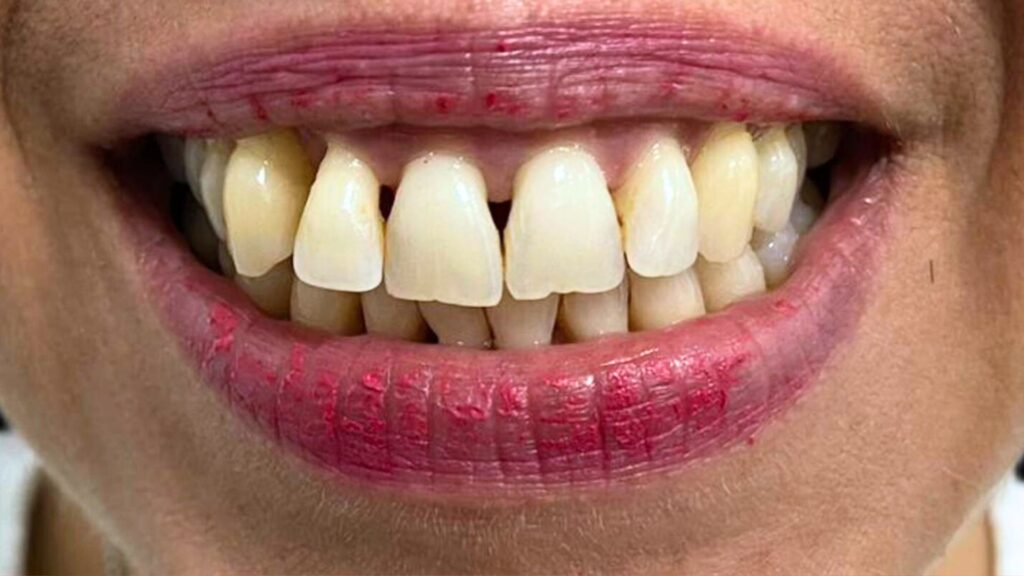 antes y despues estetica dental