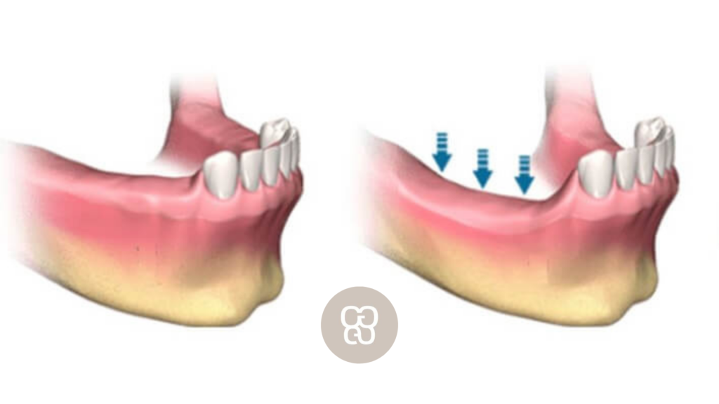 muchos años sin dientes