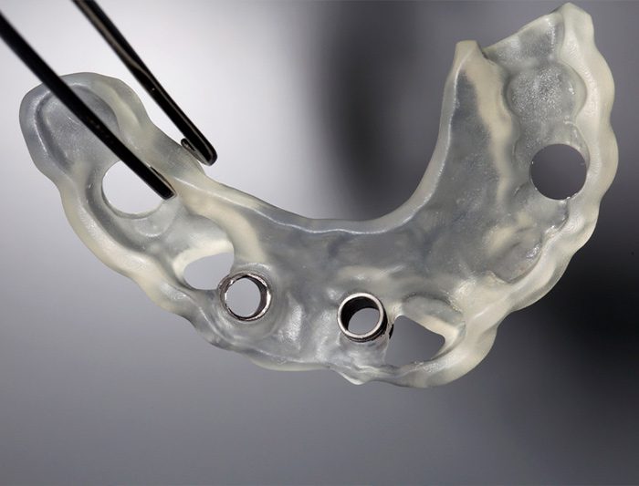 cirugía guiada para implantes dentales