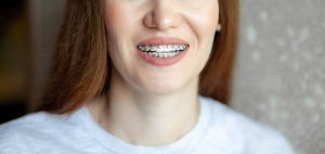 ortodoncia con brackets