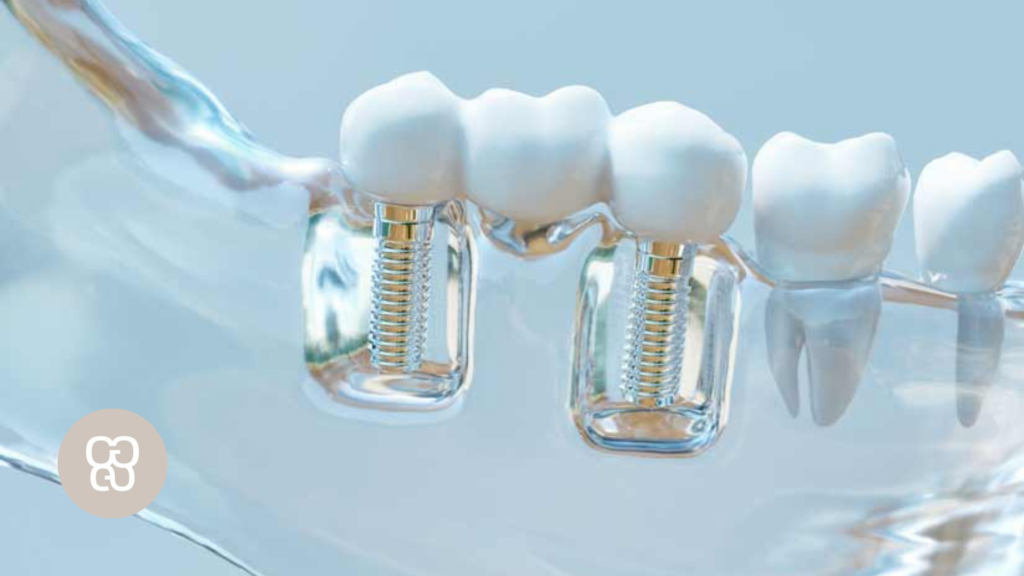 Errores después de ponerse un implante dental