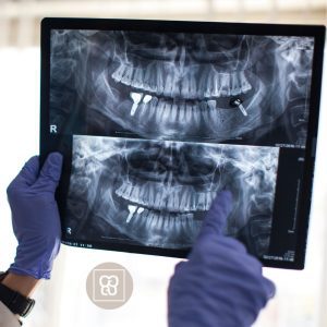 implantes dentales en arganzuela