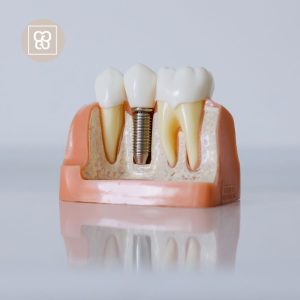 implante dental en embajadores