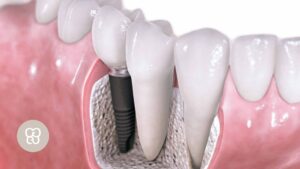 Acortar tiempos en la colocación de implantes en clínica dental ferrocarril