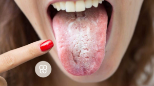 liquen plano oral en clínica dental ferrocarril